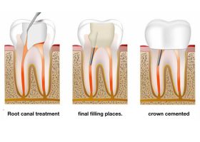 root-canal-treatment-2